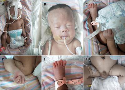 Transmission of a Novel Imprinting Center Deletion Associated With Prader–Willi Syndrome Through Three Generations of a Chinese Family: Case Presentation, Differential Diagnosis, and a Lesson Worth Thinking About